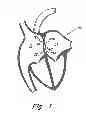 Fig. 02 - Catch member for PFO occluder