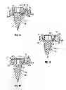 Fig. 02 - Locking confirmation mechanism for a bone screw and plate assembly