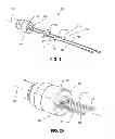 Fig. 02 - Implant retaining loop and guide wire extension