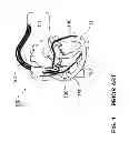 Fig. 02 - Unipolar multipurpose electrode line and stimulation and defibrillation assembly