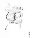 Fig. 03 - Unipolar multipurpose electrode line and stimulation and defibrillation assembly