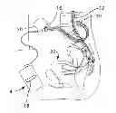 Fig. 01 - Laparoscopic implantation of neurostimulators