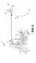 Fig. 06 - Laparoscopic implantation of neurostimulators