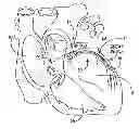 Fig. 01 - Intravascular medical device with advancable electrode
