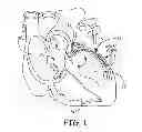 Fig. 02 - Intravascular medical device with advancable electrode