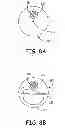 Fig. 09 - Intravascular medical device with advancable electrode