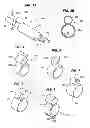 Fig. 04 - Ostial stenting system
