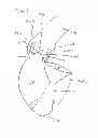 Fig. 03 - Oval Aortic Valve