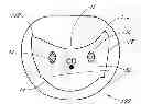 Fig. 01 - Device, system, and method for transcatheter treatment of valve regurgitation