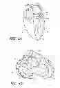 Fig. 02 - Device, system, and method for transcatheter treatment of valve regurgitation
