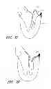 Fig. 07 - Device, system, and method for transcatheter treatment of valve regurgitation