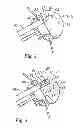 Fig. 03 - System for replacing an intervertebral disc