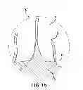 Fig. 07 - COMPOSITE IMPLANT