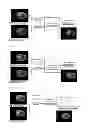 Fig. 05 - Method of processing medical image of blood vessel using image fusion method