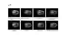 Fig. 06 - Method of processing medical image of blood vessel using image fusion method