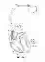 Fig. 02 - DEVICES, SYSTEMS AND METHODS TO INCREASE COMPLIANCE WITH A PREDETERMINED VENTRICULAR ELECTRICAL ACTIVATION PATTERN