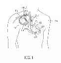 Fig. 02 - Feedthrough configured for interconnect