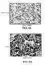 Fig. 06 - KLF6 ALTERNATIVE SPLICE FORMS AND A GERMLINE KLF6 DNA POLYMORPHISM ASSOCIATED WITH INCREASED CANCER RISK