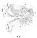 Fig. 02 - Electromagnetic bone conduction hearing device