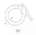 Fig. 08 - Adjustable implant and method of use