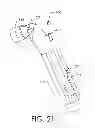 Fig. 22 - Adjustable implant and method of use