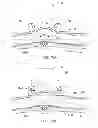 Fig. 76 - Adjustable implant and method of use