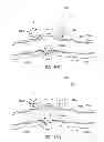 Fig. 77 - Adjustable implant and method of use