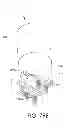Fig. 83 - Adjustable implant and method of use