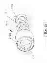 Fig. 85 - Adjustable implant and method of use