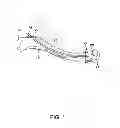 Fig. 02 - Pre-curved intramedullary clavicle nail and method of using same