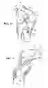 Fig. 02 - Suspension device to anchor tissue graft