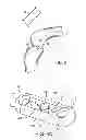 Fig. 03 - Suspension device to anchor tissue graft