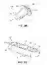 Fig. 04 - Suspension device to anchor tissue graft