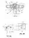 Fig. 06 - Suspension device to anchor tissue graft