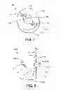 Fig. 07 - Suspension device to anchor tissue graft