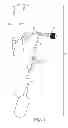 Fig. 02 - Method of implanting a penile prosthetic deflation assembly having a palpatable activation surface
