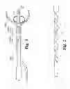 Fig. 02 - Self-Cleansing Bladder Drainage Catheter