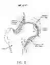Fig. 07 - Method and apparatus for treating a hip joint, including the provision and use of a novel suture passer