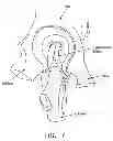 Fig. 08 - Method and apparatus for treating a hip joint, including the provision and use of a novel suture passer