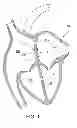 Fig. 02 - Heart occlusion devices