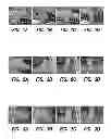 Fig. 02 - Method for treating prostate cancer