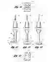 Fig. 04 - Method for preparing an implant site and laterally inserting a dental implant