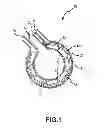 Fig. 02 - Apparatus and method for cooling and moving ablation elements