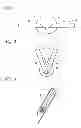 Fig. 02 - BODY LUMEN OCCLUSION APPARATUS AND METHODS