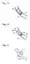Fig. 15 - BODY LUMEN OCCLUSION APPARATUS AND METHODS