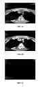 Fig. 06 - Method and system for design of spectral filter to classify tissue and material from multi-energy images