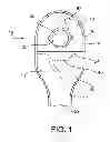 Fig. 02 - Ostomy devices