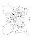 Fig. 02 - PRECISE FEMORAL COMPONENT POSITIONING FOR HIP REPLACEMENT SURGERY