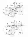 Fig. 04 - PRECISE FEMORAL COMPONENT POSITIONING FOR HIP REPLACEMENT SURGERY