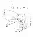 Fig. 08 - PRECISE FEMORAL COMPONENT POSITIONING FOR HIP REPLACEMENT SURGERY